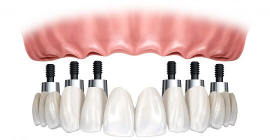 Implantes Dentários