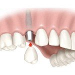 Implantes dentários falsificados colocam em risco a saúde dos pacientes