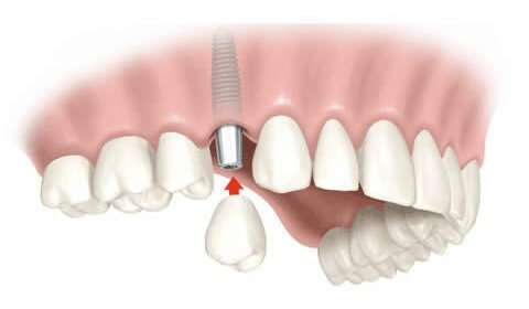 Implantes dentários falsificados colocam em risco a saúde dos pacientes