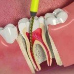 Endodontia – Tratamento de Canal