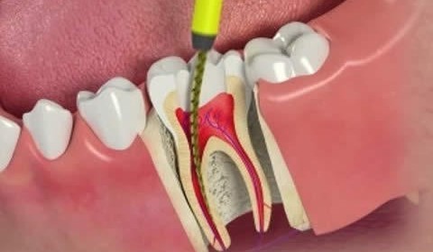 Endodontia – Tratamento de Canal