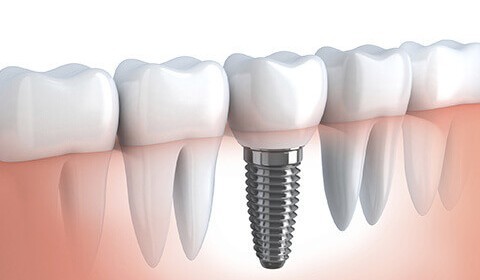 Implante Dentário – existe garantia de sucesso?