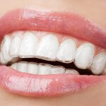 Ortodontia com alinhadores invisíveis: INVISALIGN