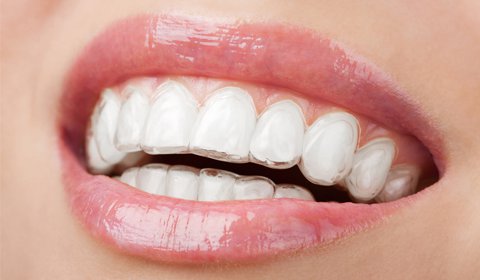 Ortodontia com alinhadores invisíveis: INVISALIGN