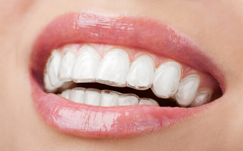 Ortodontia com alinhadores invisíveis: INVISALIGN